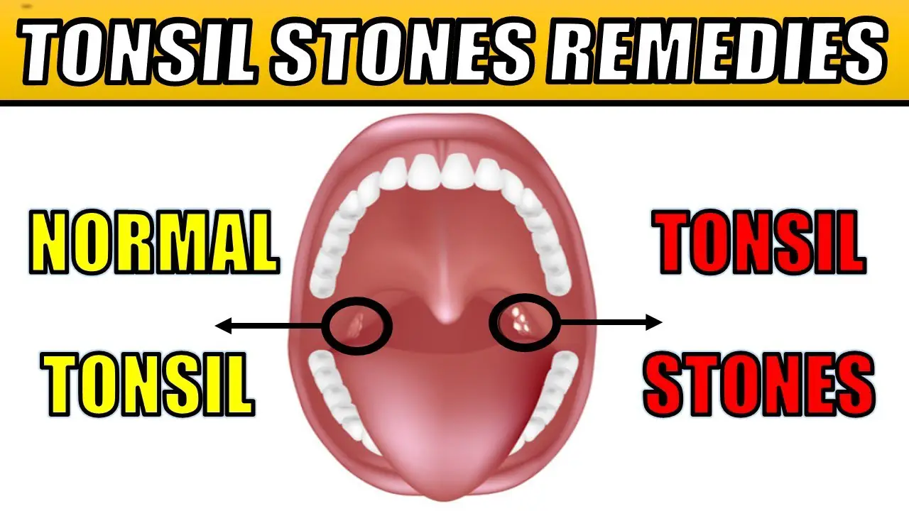 Tonsil Stones Causes Symptoms And Natural Treatments Epic Natural Health