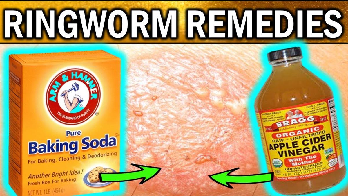 8 Best Natural Home Remedies For RINGWORM TREATMENTS