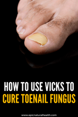 How To Use Vicks To Treat & Cure Toenail Fungus – FAST EASY REMEDY ...