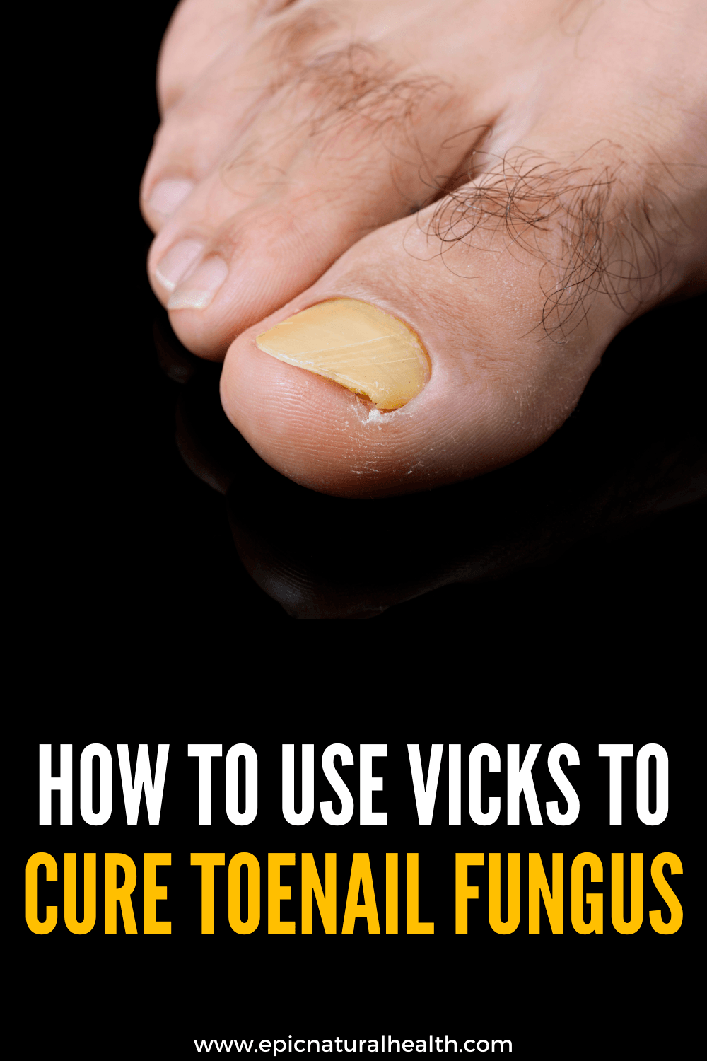 How To Use Vicks To Treat Cure Toenail Fungus FAST EASY REMEDY 