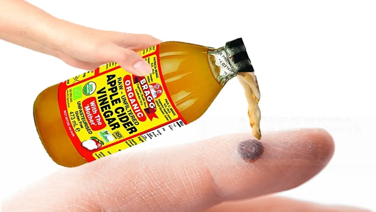 acv for warts blog image