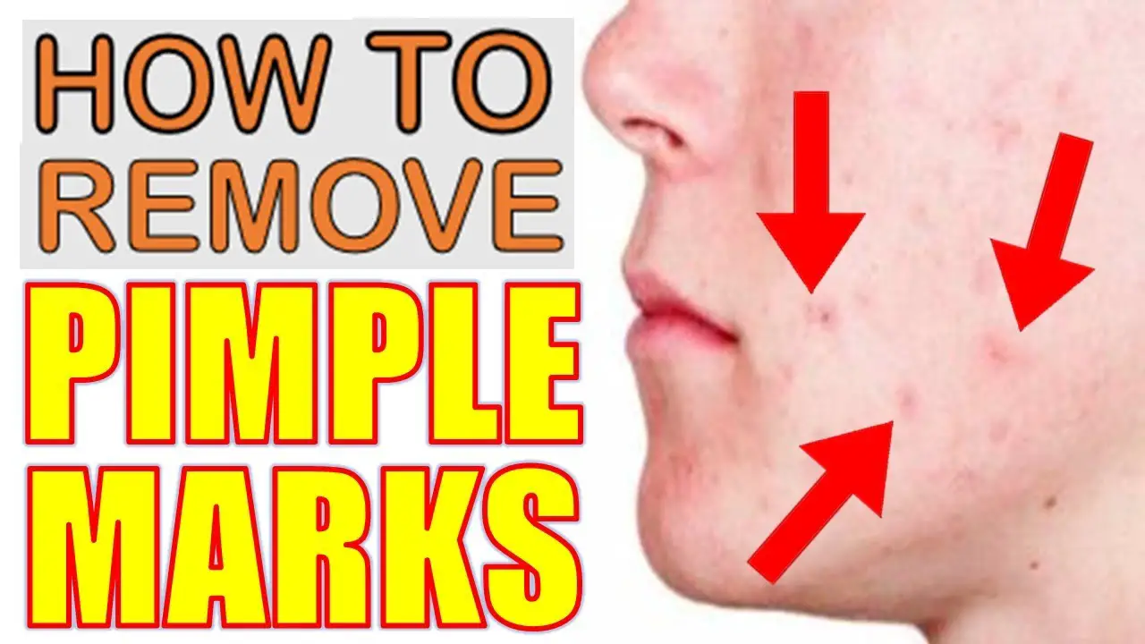 How To Remove Pimple Marks Scars Dark Spots Naturally Epic Natural 