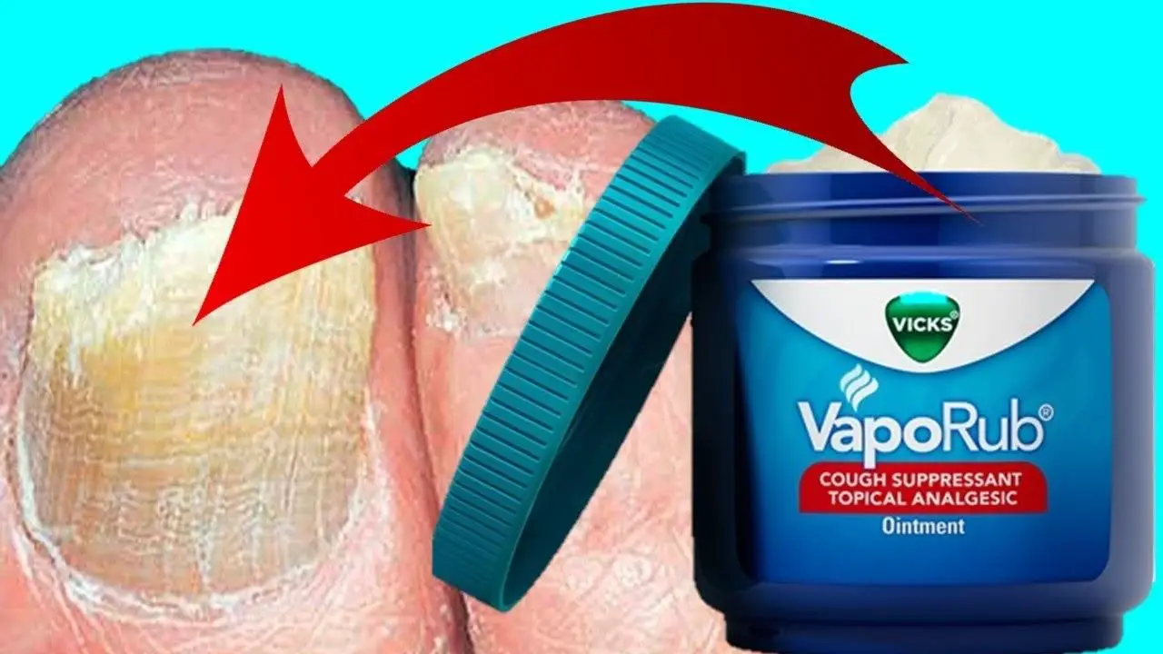 How To Use Vicks To Treat Cure Toenail Fungus FAST EASY REMEDY 