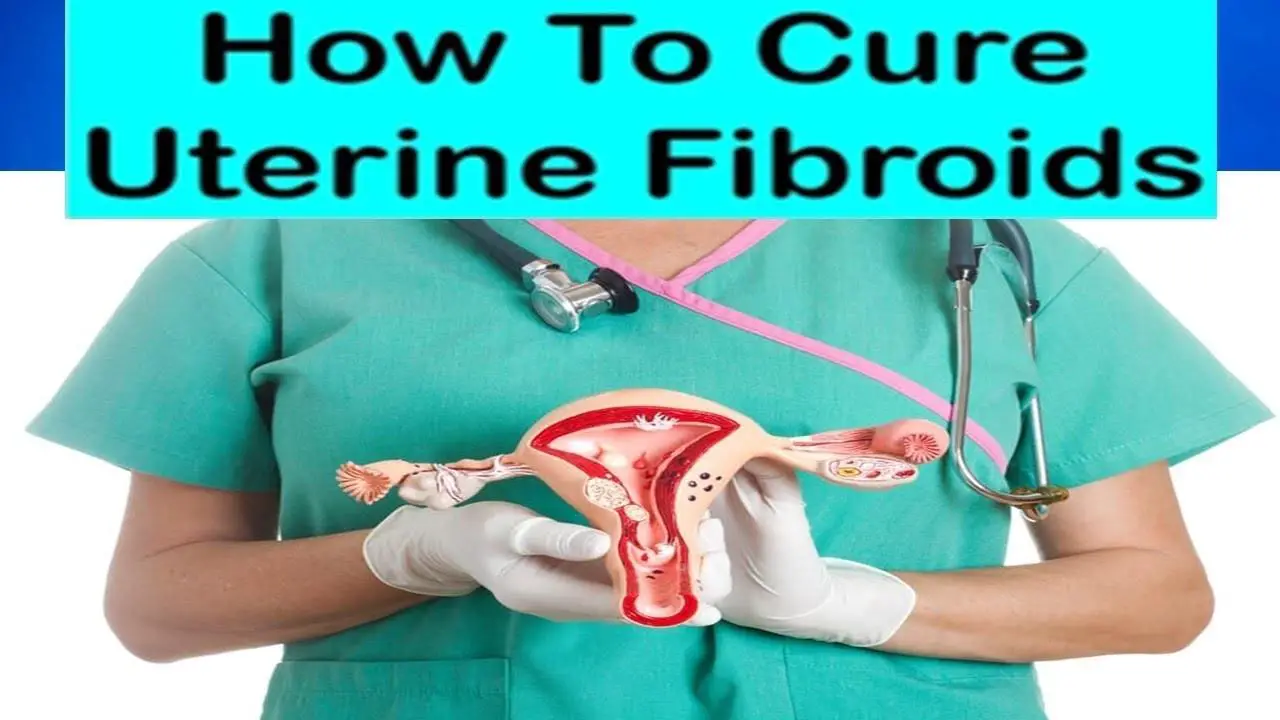 Fibroids Symptoms And Home Remedies To Naturally Treat Fibroids At Home Epic Natural Health