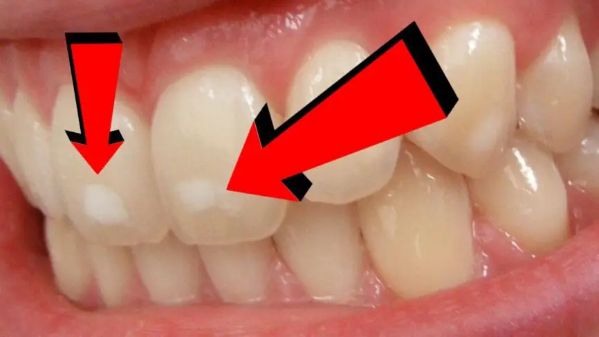 What Causes White Spots On Teeth | How To Cure It – Home Remedies ...