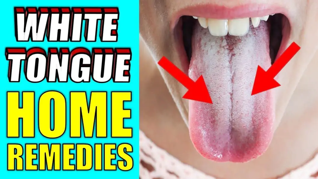 What Causes White Tongue | HOW TO GET RID OF WHITE TONGUE QUICKLY