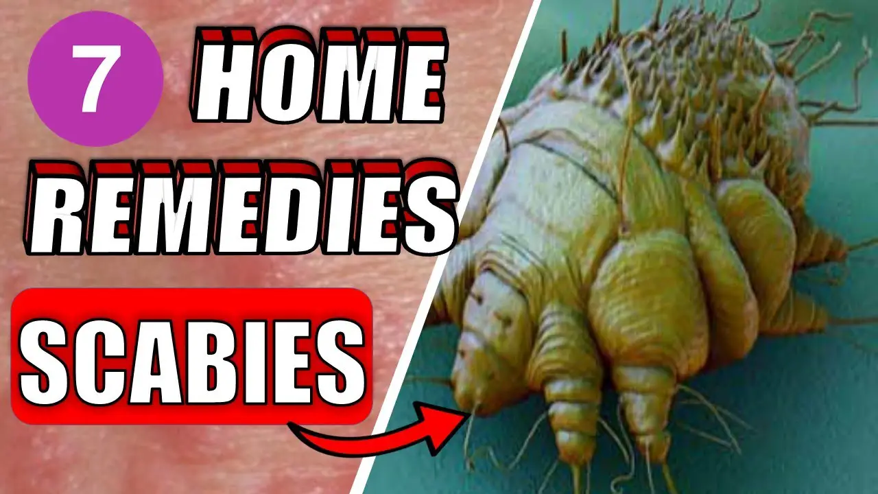 7 Effective Scabies Home Natural Treatments Epic Natural Health 0812