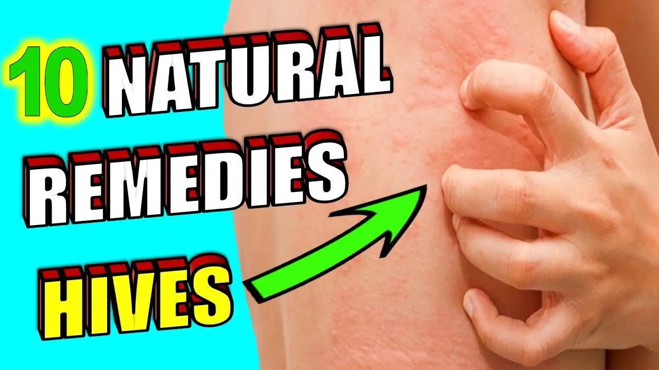 10-natural-remedies-for-skin-hives-treatment-at-home-what-are-skin