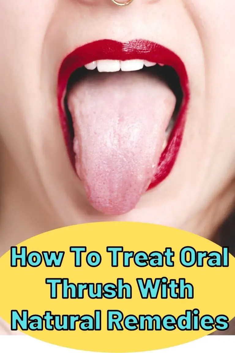 How To Treat Oral Thrush With Natural Remedies Epic Natural Health