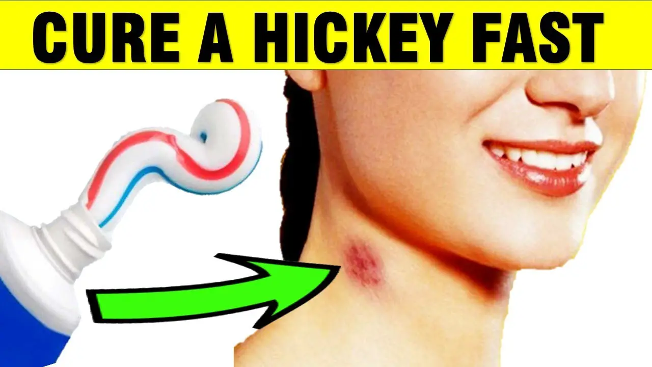 How To Get Rid Of A Hickey Love Bite Naturally Epic Natural Health